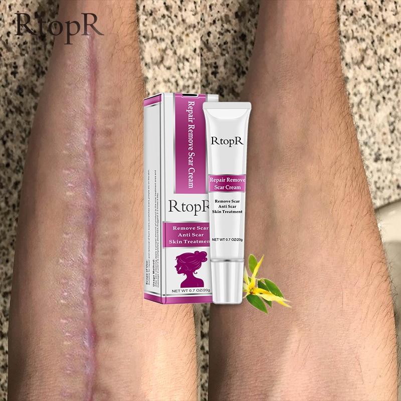 RtopR Scar Remover Cream For Stretch Marks, Acne And More!