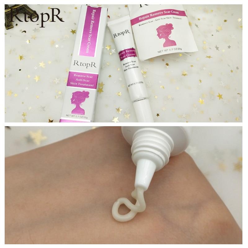 RtopR Scar Remover Cream For Stretch Marks, Acne And More!