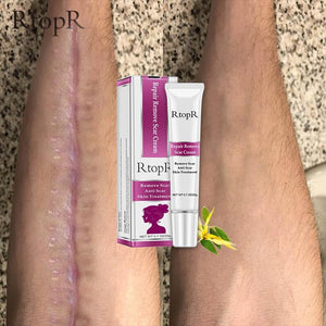 RtopR Scar Remover Cream For Stretch Marks, Acne And More!