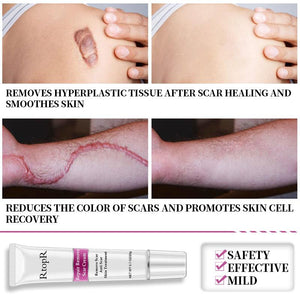 RtopR Scar Remover Cream For Stretch Marks, Acne And More!