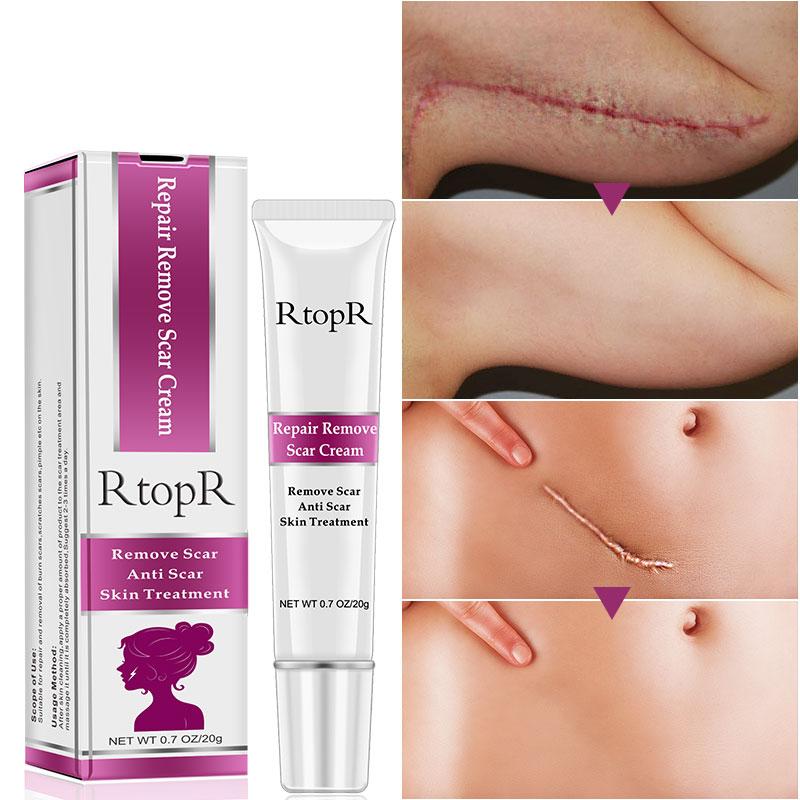 RtopR Scar Remover Cream For Stretch Marks, Acne And More!