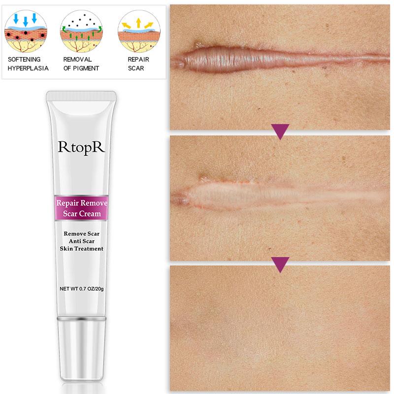 RtopR Scar Remover Cream For Stretch Marks, Acne And More!